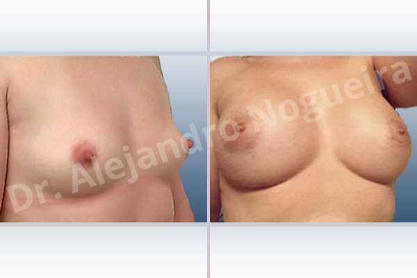 Asymmetric breasts,Lateral breasts,Small breasts,Too far apart wide cleavage breasts,Anatomical shape,Extra large size,Lower hemi periareolar incision,Subfascial pocket plane - photo 5