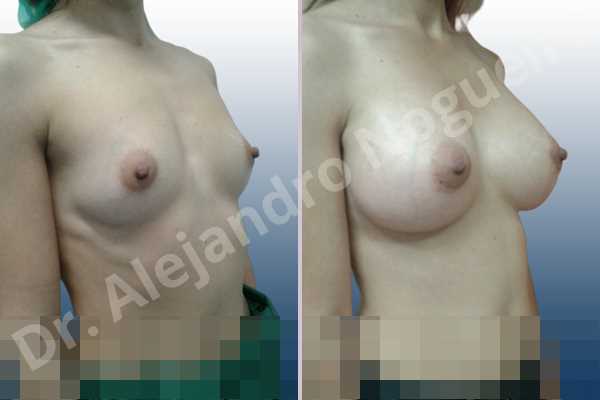 Empty breasts,Narrow breasts,Pigeon chest,Skinny breasts,Small breasts,Too far apart wide cleavage breasts,Anatomical shape,Extra large size,Lower hemi periareolar incision,Subfascial pocket plane - photo 5