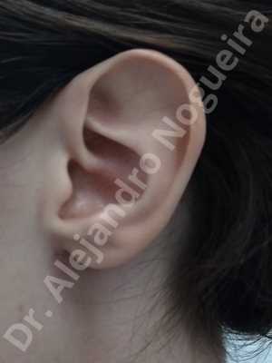 Large ears,Prominent ears,Fleur de lis cephalic ear resection