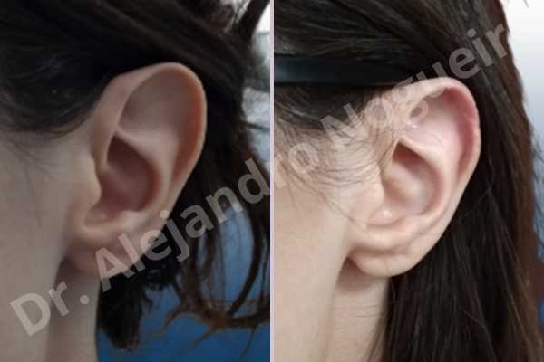 Large ears,Prominent ears,Fleur de lis cephalic ear resection - photo 2