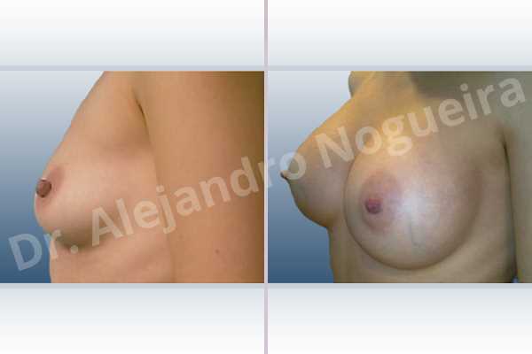 Empty breasts,Lateral breasts,Skinny breasts,Slightly saggy droopy breasts,Small breasts,Sunken chest,Too far apart wide cleavage breasts,Anatomical shape,Extra large size,Lower hemi periareolar incision,Subfascial pocket plane - photo 2