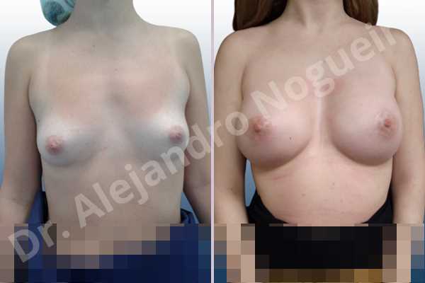 Asymmetric breasts,Empty breasts,Lateral breasts,Narrow breasts,Small breasts,Sunken chest,Too far apart wide cleavage breasts,Anatomical shape,Circumareolar incision,Subfascial pocket plane - photo 1