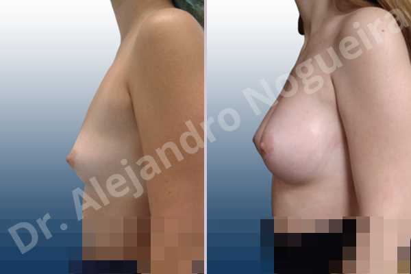 Asymmetric breasts,Empty breasts,Lateral breasts,Narrow breasts,Small breasts,Sunken chest,Too far apart wide cleavage breasts,Anatomical shape,Circumareolar incision,Subfascial pocket plane - photo 2