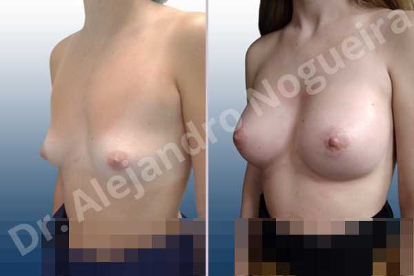 Asymmetric breasts,Empty breasts,Lateral breasts,Narrow breasts,Small breasts,Sunken chest,Too far apart wide cleavage breasts,Anatomical shape,Circumareolar incision,Subfascial pocket plane - photo 3