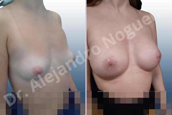 Asymmetric breasts,Empty breasts,Lateral breasts,Narrow breasts,Small breasts,Sunken chest,Too far apart wide cleavage breasts,Anatomical shape,Circumareolar incision,Subfascial pocket plane - photo 5