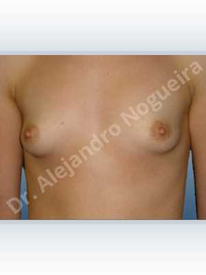 Asymmetric breasts,Lateral breasts,Narrow breasts,Pigeon chest,Skinny breasts,Small breasts,Too far apart wide cleavage breasts,Tuberous breasts,Anatomical shape,Lower hemi periareolar incision,Subfascial pocket plane,Tuberous mammoplasty
