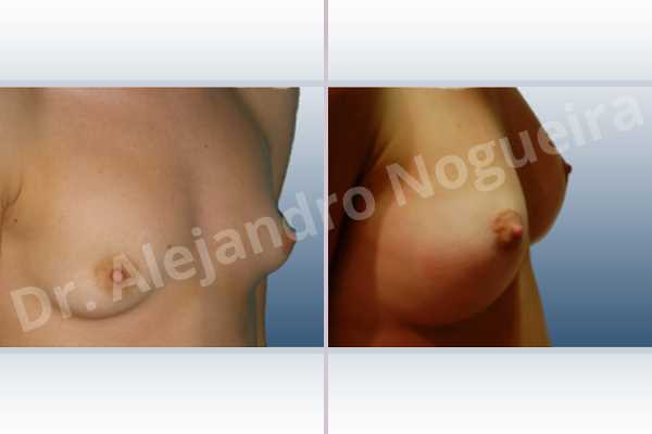Asymmetric breasts,Lateral breasts,Narrow breasts,Pigeon chest,Skinny breasts,Small breasts,Too far apart wide cleavage breasts,Tuberous breasts,Anatomical shape,Lower hemi periareolar incision,Subfascial pocket plane,Tuberous mammoplasty - photo 3