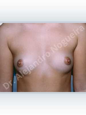 Cross eyed breasts,Lateral breasts,Narrow breasts,Small breasts,Tuberous breasts,Anatomical shape,Lower hemi periareolar incision,Subfascial pocket plane