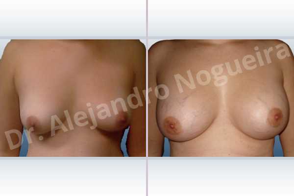 Asymmetric breasts,Lateral breasts,Mildly saggy droopy breasts,Moderately saggy droopy breasts,Small breasts,Waterfall effect breast implants,Anatomical shape,Lower hemi periareolar incision,Subfascial pocket plane - photo 1