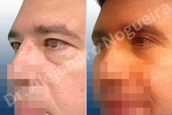Baggy lower eyelids,Baggy upper eyelids,Saggy upper eyelids,Upper eyelids ptosis,Lower eyelid fat bags resection,Transconjunctival approach incision,Upper eyelid fat bags resection,Upper eyelid skin and muscle resection - photo 3