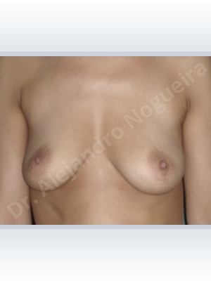 Asymmetric breasts,Cross eyed breasts,Empty breasts,Lateral breasts,Mildly saggy droopy breasts,Moderately saggy droopy breasts,Pendulous breasts,Pigeon chest,Skinny breasts,Small breasts,Wide breasts,Anatomical shape,Lollipop incision,Subfascial pocket plane,Superior pedicle