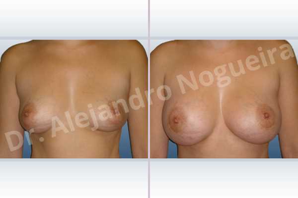 Asymmetric breasts,Cross eyed breasts,Lateral breasts,Small breasts,Tuberous breasts,Anatomical shape,Lower hemi periareolar incision,Subfascial pocket plane,Tuberous mammoplasty - photo 1