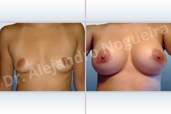 Asymmetric breasts,Cross eyed breasts,Empty breasts,Narrow breasts,Small breasts,Anatomical shape,Extra large size,Lower hemi periareolar incision,Subfascial pocket plane - photo 1