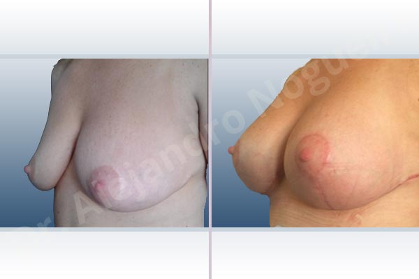 Asymmetric breasts,Displaced malpositioned scars,Empty breasts,Failed breast lift,Mildly saggy droopy breasts,Wide scars,Anatomical shape,Anchor incision,Excisional scar revision,Subfascial pocket plane,Superior pedicle - photo 3