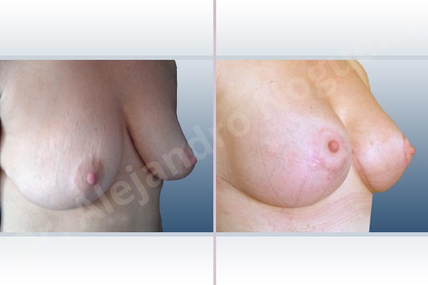 Asymmetric breasts,Displaced malpositioned scars,Empty breasts,Failed breast lift,Mildly saggy droopy breasts,Wide scars,Anatomical shape,Anchor incision,Excisional scar revision,Subfascial pocket plane,Superior pedicle - photo 5