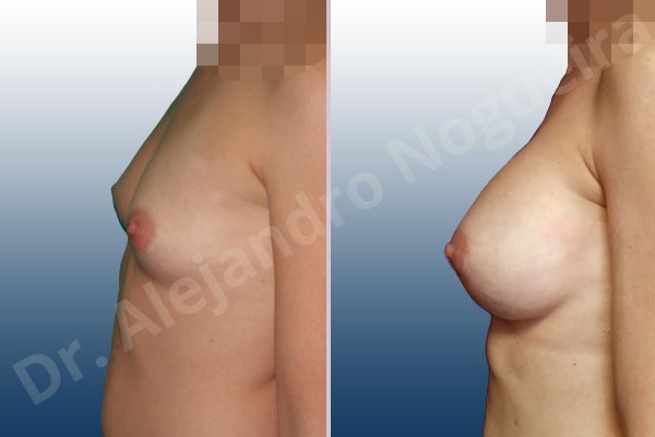 Cross eyed breasts,Empty breasts,Lateral breasts,Narrow breasts,Skinny breasts,Slightly saggy droopy breasts,Too far apart wide cleavage breasts,Lower hemi periareolar incision,Round shape,Dual plane pocket - photo 2