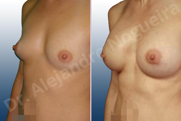 Cross eyed breasts,Empty breasts,Lateral breasts,Narrow breasts,Skinny breasts,Slightly saggy droopy breasts,Too far apart wide cleavage breasts,Lower hemi periareolar incision,Round shape,Dual plane pocket - photo 3