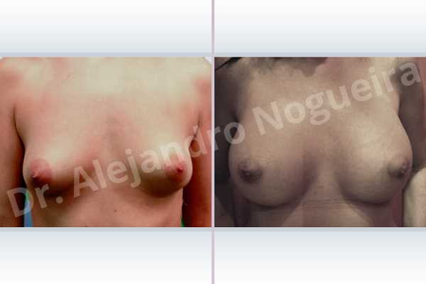 Lateral breasts,Narrow breasts,Small breasts,Too far apart wide cleavage breasts,Tuberous breasts,Anatomical shape,Lower hemi periareolar incision,Subfascial pocket plane,Tuberous mammoplasty - photo 1