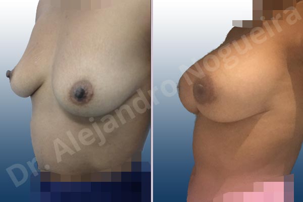 Empty breasts,Lateral breasts,Slightly saggy droopy breasts,Small breasts,Too far apart wide cleavage breasts,Wide breasts,Anatomical shape,Extra large size,Lower hemi periareolar incision,Subfascial pocket plane - photo 2