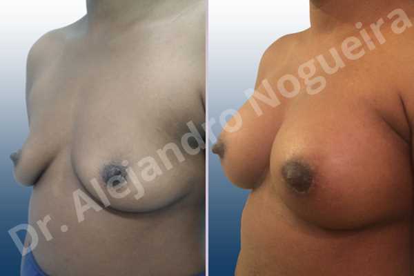 Empty breasts,Lateral breasts,Slightly saggy droopy breasts,Small breasts,Anatomical shape,Lower hemi periareolar incision,Subfascial pocket plane - photo 3