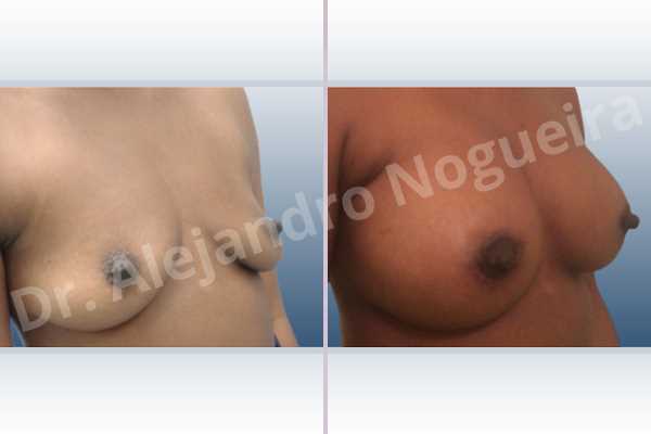 Empty breasts,Lateral breasts,Slightly saggy droopy breasts,Small breasts,Anatomical shape,Lower hemi periareolar incision,Subfascial pocket plane - photo 5