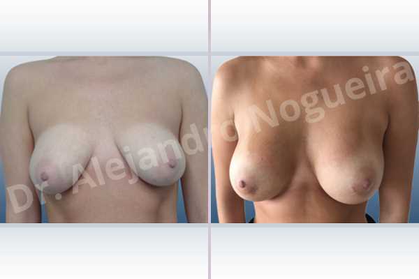 Asymmetric breasts,Empty breasts,Lateral breasts,Moderately saggy droopy breasts,Small breasts,Too far apart wide cleavage breasts,Anatomical shape,Lower hemi periareolar incision,Subfascial pocket plane - photo 1