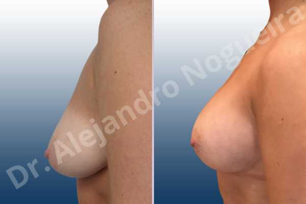Asymmetric breasts,Empty breasts,Lateral breasts,Moderately saggy droopy breasts,Small breasts,Too far apart wide cleavage breasts,Anatomical shape,Lower hemi periareolar incision,Subfascial pocket plane - photo 2