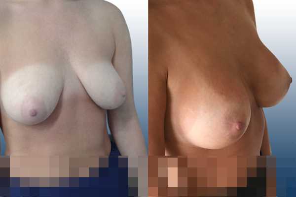 Asymmetric breasts,Empty breasts,Lateral breasts,Moderately saggy droopy breasts,Small breasts,Too far apart wide cleavage breasts,Anatomical shape,Lower hemi periareolar incision,Subfascial pocket plane - photo 5