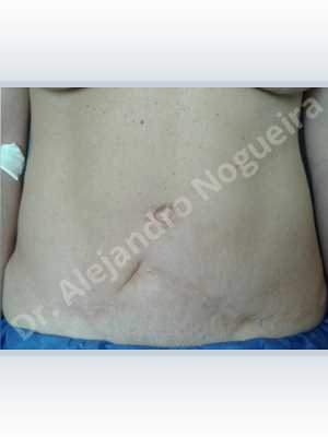 Displaced malpositioned scars,Failed tummy tuck,Hypertrophic scars,Keloid scars,Sunken scars,Wide scars,Excisional scar revision,Fleur de lis abdominoplasty
