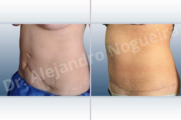 Displaced malpositioned scars,Failed tummy tuck,Hypertrophic scars,Keloid scars,Sunken scars,Wide scars,Excisional scar revision,Fleur de lis abdominoplasty - photo 4