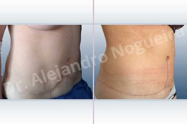Displaced malpositioned scars,Failed tummy tuck,Hypertrophic scars,Keloid scars,Sunken scars,Wide scars,Excisional scar revision,Fleur de lis abdominoplasty - photo 6