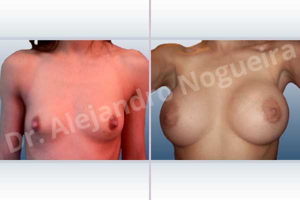Asymmetric breasts,Lateral breasts,Skinny breasts,Small breasts,Too far apart wide cleavage breasts,Extra large size,Lower hemi periareolar incision,Round shape,Subfascial pocket plane - photo 1