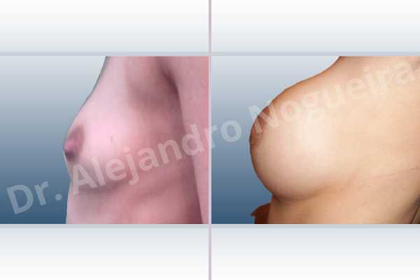 Asymmetric breasts,Lateral breasts,Skinny breasts,Small breasts,Too far apart wide cleavage breasts,Extra large size,Lower hemi periareolar incision,Round shape,Subfascial pocket plane - photo 2