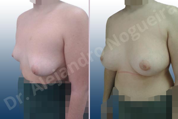 Asymmetric breasts,Empty breasts,Lateral breasts,Moderately saggy droopy breasts,Small breasts,Too far apart wide cleavage breasts,Tuberous breasts,Wide breasts,Anatomical shape,Inframammary incision,Lower hemi periareolar incision,Subfascial pocket plane,Tuberous mammoplasty - photo 3