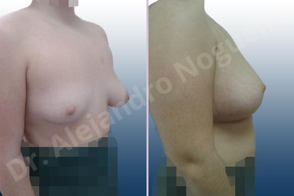 Asymmetric breasts,Empty breasts,Lateral breasts,Moderately saggy droopy breasts,Small breasts,Too far apart wide cleavage breasts,Tuberous breasts,Wide breasts,Anatomical shape,Inframammary incision,Lower hemi periareolar incision,Subfascial pocket plane,Tuberous mammoplasty - photo 4