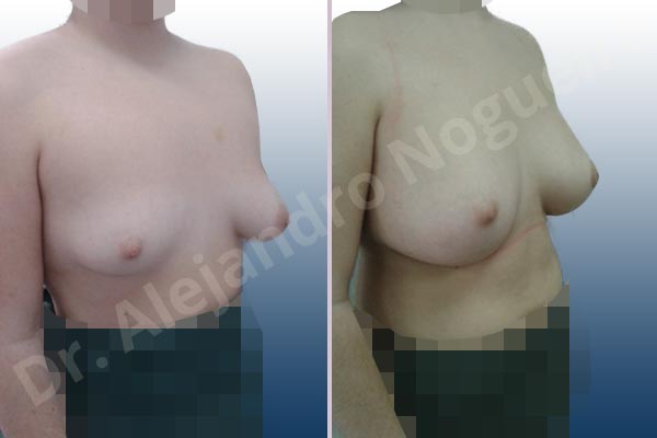 Asymmetric breasts,Empty breasts,Lateral breasts,Moderately saggy droopy breasts,Small breasts,Too far apart wide cleavage breasts,Tuberous breasts,Wide breasts,Anatomical shape,Inframammary incision,Lower hemi periareolar incision,Subfascial pocket plane,Tuberous mammoplasty - photo 5