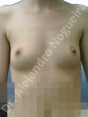 Asymmetric breasts,Cross eyed breasts,Lateral breasts,Narrow breasts,Pigeon chest,Skinny breasts,Small breasts,Anatomical shape,Lower hemi periareolar incision,Subfascial pocket plane