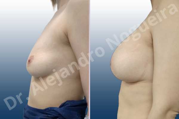Asymmetric breasts,Empty breasts,Mildly saggy droopy breasts,Slightly saggy droopy breasts,Small breasts,Wide breasts,Anatomical shape,Lower hemi periareolar incision,Subfascial pocket plane - photo 2