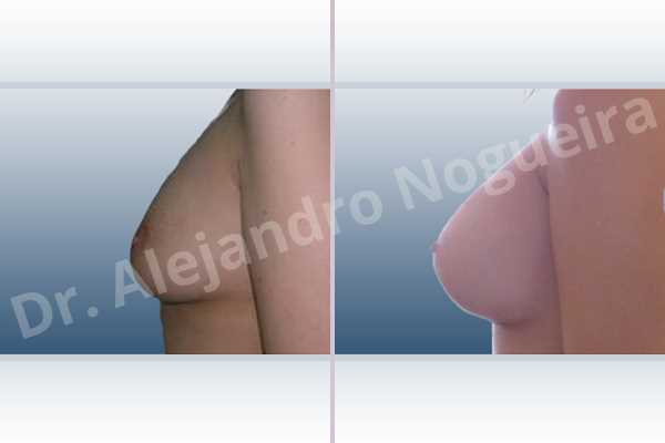 Asymmetric breasts,Empty breasts,Mildly saggy droopy breasts,Moderately saggy droopy breasts,Narrow breasts,Small breasts,Anatomical shape,Lower hemi periareolar incision,Subfascial pocket plane - photo 2