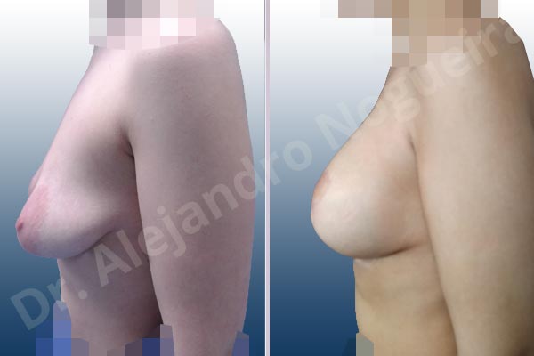 Asymmetric breasts,Empty breasts,Large areolas,Lateral breasts,Moderately saggy droopy breasts,Narrow breasts,Pendulous breasts,Pigeon chest,Skinny breasts,Small breasts,Too far apart wide cleavage breasts,Tuberous breasts,Anatomical shape,Areola reduction,Lollipop incision,Subfascial pocket plane,Superior pedicle - photo 2