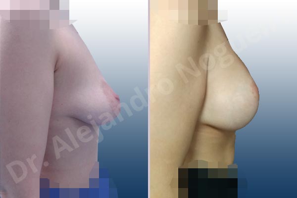 Asymmetric breasts,Empty breasts,Large areolas,Lateral breasts,Moderately saggy droopy breasts,Narrow breasts,Pendulous breasts,Pigeon chest,Skinny breasts,Small breasts,Too far apart wide cleavage breasts,Tuberous breasts,Anatomical shape,Areola reduction,Lollipop incision,Subfascial pocket plane,Superior pedicle - photo 4