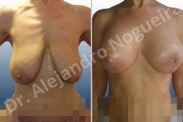 Asymmetric breasts,Empty breasts,Extremely saggy droopy breasts,Large areolas,Mildly large breasts,Pendulous breasts,Tuberous breasts,Anatomical shape,Anchor incision,Areola reduction,Double vertical pedicle,Subfascial pocket plane - photo 1