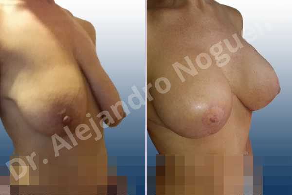 Asymmetric breasts,Empty breasts,Extremely saggy droopy breasts,Large areolas,Mildly large breasts,Pendulous breasts,Tuberous breasts,Anatomical shape,Anchor incision,Areola reduction,Double vertical pedicle,Subfascial pocket plane - photo 4