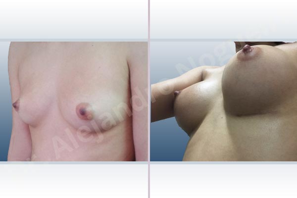 Asymmetric breasts,Cross eyed breasts,Empty breasts,Narrow breasts,Skinny breasts,Small breasts,Inframammary incision,Round shape,Subfascial pocket plane - photo 3