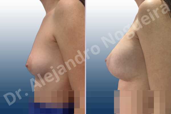 Asymmetric breasts,Empty breasts,Lateral breasts,Small breasts,Sunken chest,Too far apart wide cleavage breasts,Wide breasts,Anatomical shape,Lower hemi periareolar incision,Subfascial pocket plane - photo 2