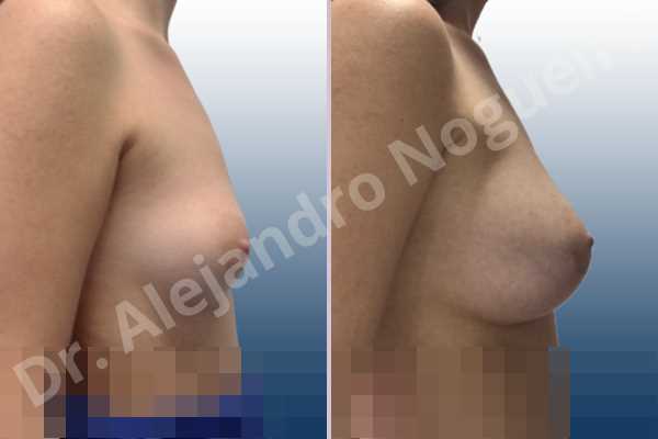 Asymmetric breasts,Empty breasts,Lateral breasts,Small breasts,Sunken chest,Too far apart wide cleavage breasts,Wide breasts,Anatomical shape,Lower hemi periareolar incision,Subfascial pocket plane - photo 4