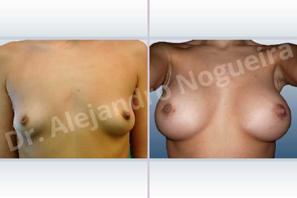 Asymmetric breasts,Inverted nipples,Lateral breasts,Narrow breasts,Pigeon chest,Small breasts,Sunken chest,Too far apart wide cleavage breasts,Tuberous breasts,Anatomical shape,Lower hemi periareolar incision,Subfascial pocket plane,Tuberous mammoplasty - photo 1