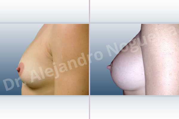 Lateral breasts,Slightly saggy droopy breasts,Small breasts,Wide breasts,Anatomical shape,Extra large size,Lower hemi periareolar incision,Subfascial pocket plane - photo 2
