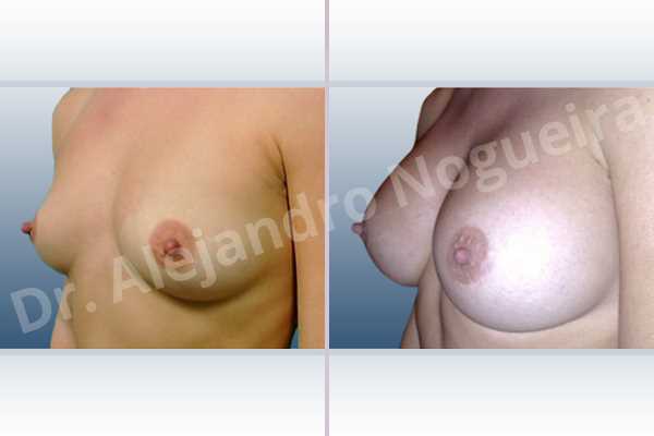 Lateral breasts,Slightly saggy droopy breasts,Small breasts,Wide breasts,Anatomical shape,Extra large size,Lower hemi periareolar incision,Subfascial pocket plane - photo 3