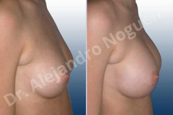 Cross eyed breasts,Small breasts,Anatomical shape,Lower hemi periareolar incision,Subfascial pocket plane - photo 4